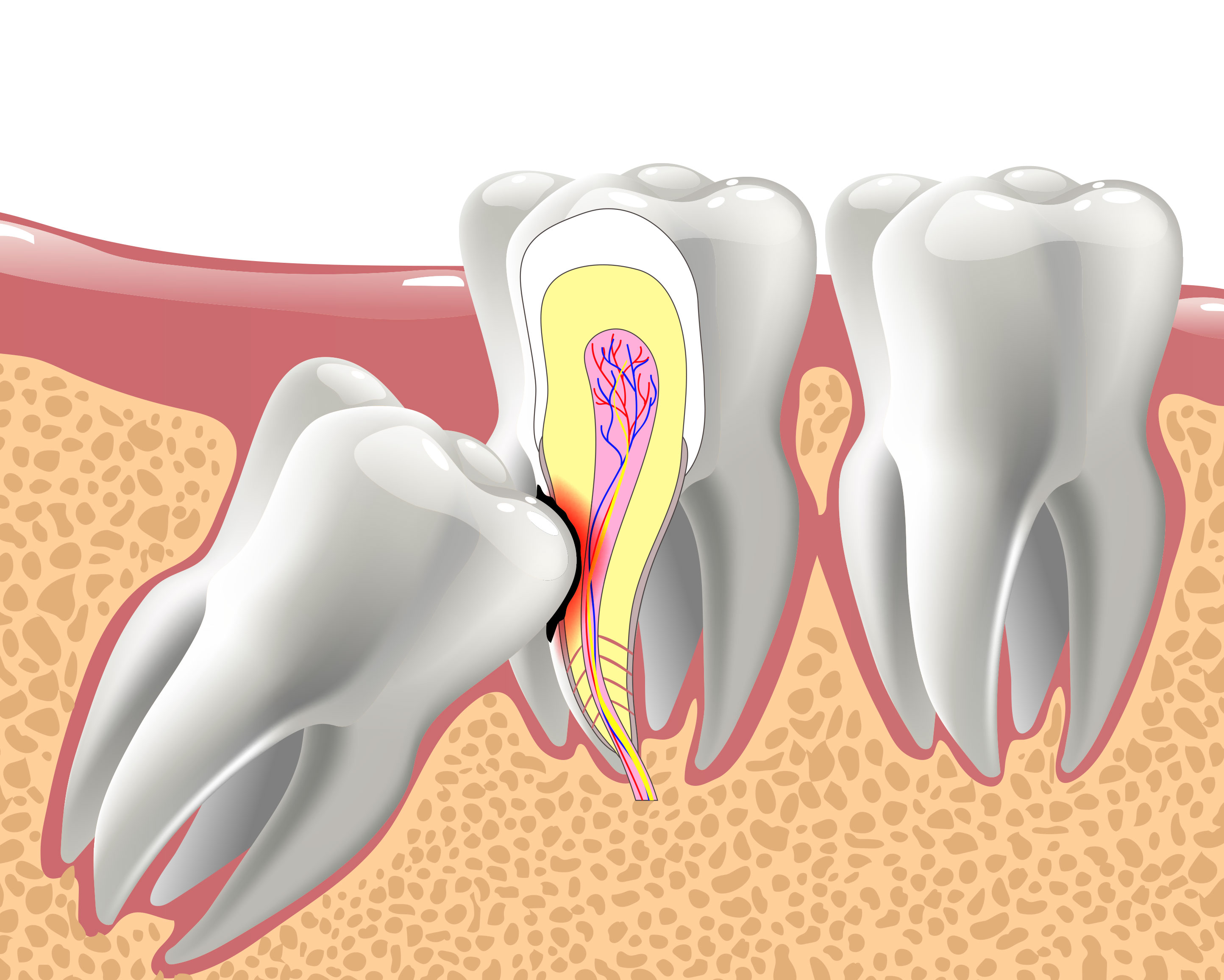 Lititz Oral Surgery | Wisdom Teeth Extractions, Impacted Teeth and Bone Grafts