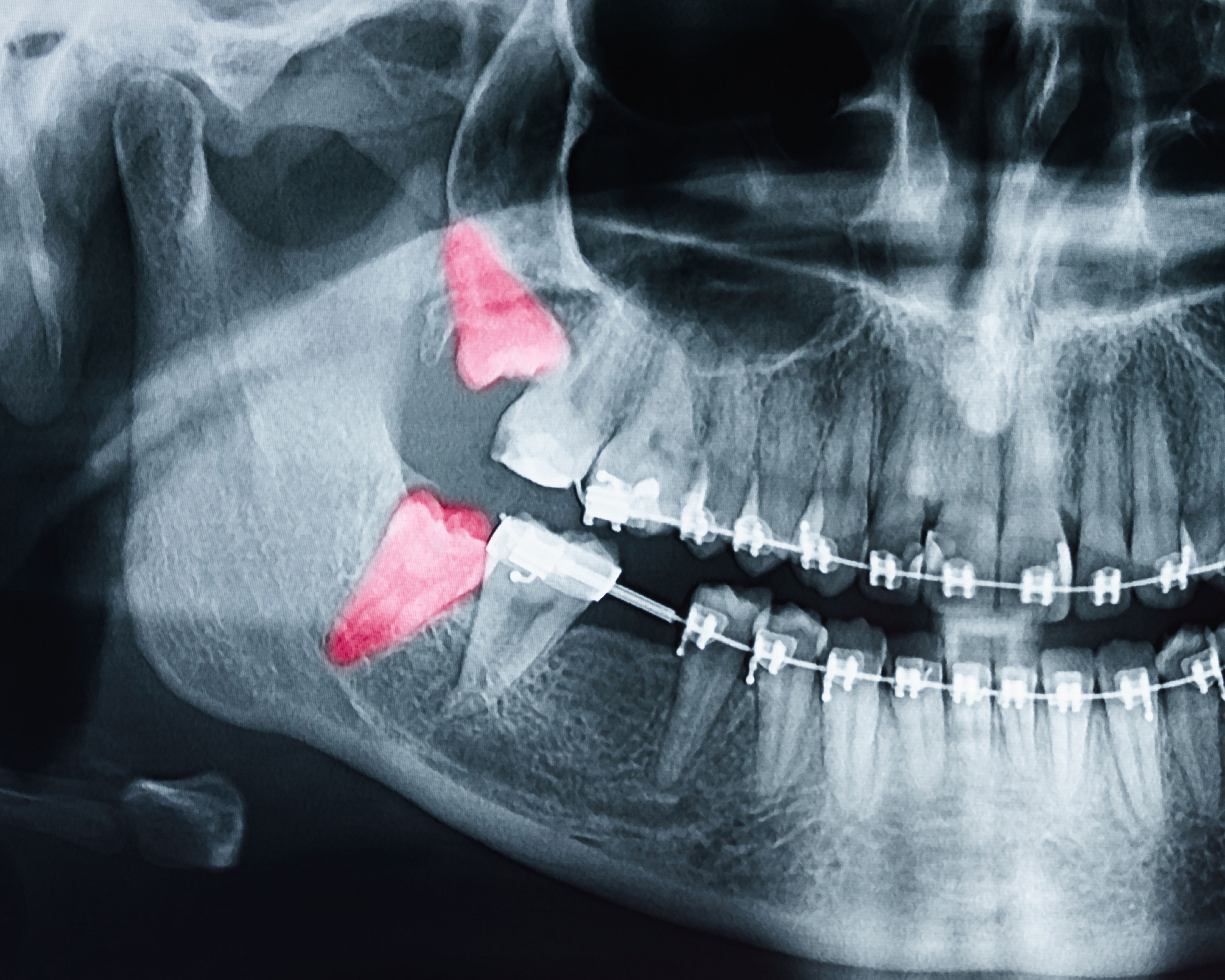 Lititz Oral Surgery | Apicoectomy, Emergency Treatment and Wisdom Teeth Extractions