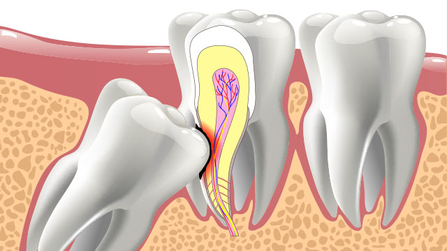 Lititz Oral Surgery | Extractions, Wisdom Teeth Extractions and Bone Grafts